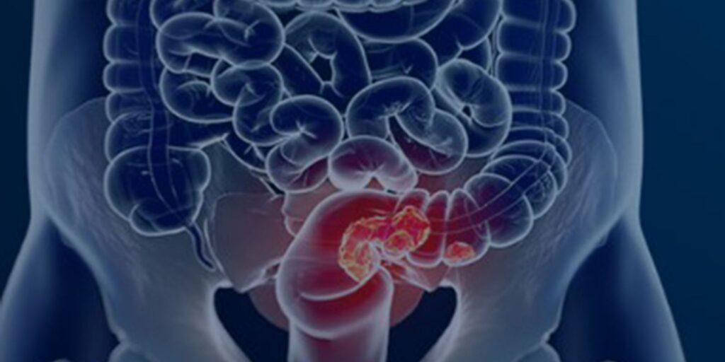 Pacientes com câncer colorretal são diagnosticados em estágio avançado