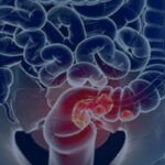 Pacientes com câncer colorretal são diagnosticados em estágio avançado