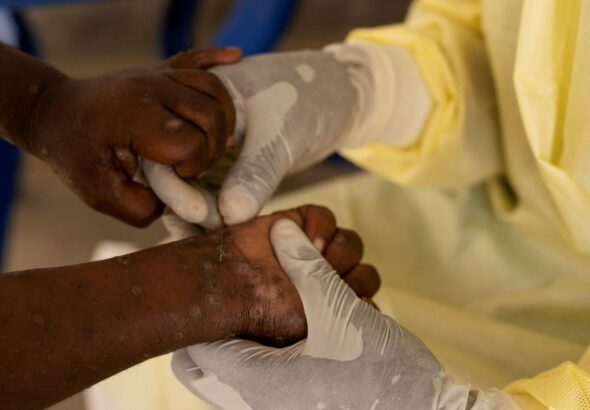 Brasil registra 88 casos de Mpox em 2026; saiba como evitar a doença