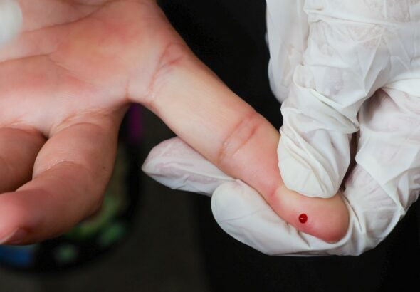 SUS passa a oferecer teste rápido de dengue