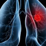 Saiba o que é adenocarcinoma pulmonar, câncer que atinge o papa